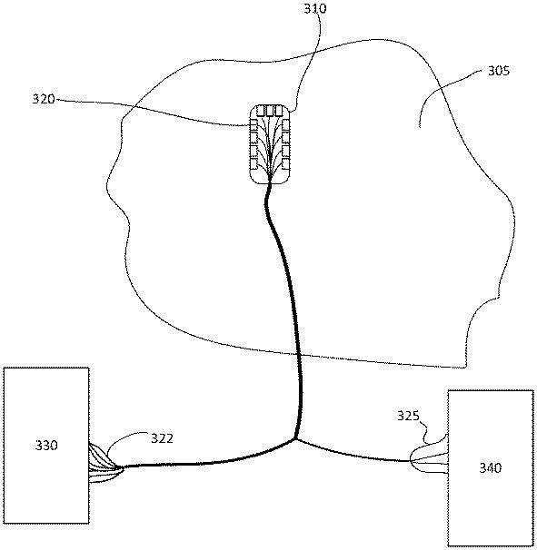 2021094390-電極のサブセットに基づく組織近接性表示 図000005