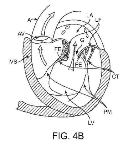 2019022777-心臓弁置換のためのデバイス、システムおよび方法 図000007