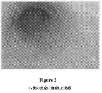 2017141303-クローン病および関連する状態および感染症を処置するための組成物および方法 図000010