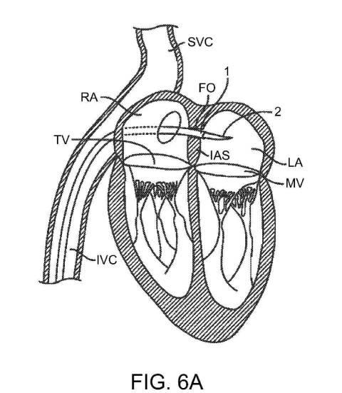 2019022777-心臓弁置換のためのデバイス、システムおよび方法 図000011