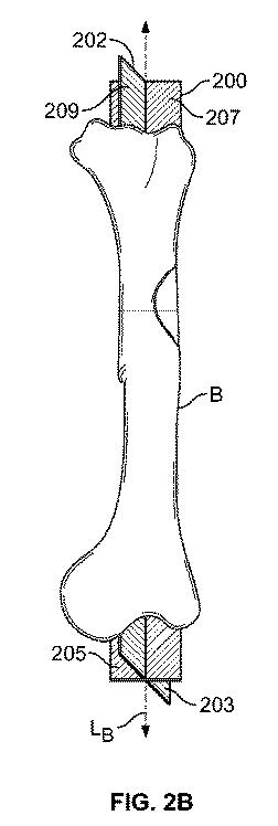 2018114305-骨修復準備のための装置および方法 図000012