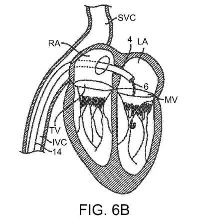 2019022777-心臓弁置換のためのデバイス、システムおよび方法 図000012