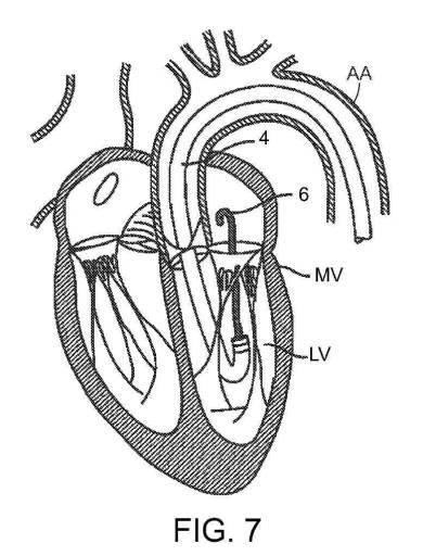 2019022777-心臓弁置換のためのデバイス、システムおよび方法 図000013