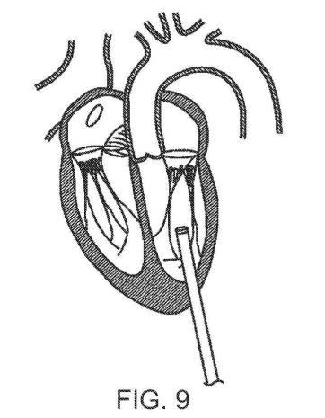 2019022777-心臓弁置換のためのデバイス、システムおよび方法 図000015
