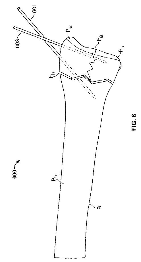 2018114305-骨修復準備のための装置および方法 図000017