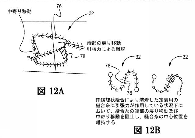 2017200593-回転針を用いた皮膚縫合装置 図000031