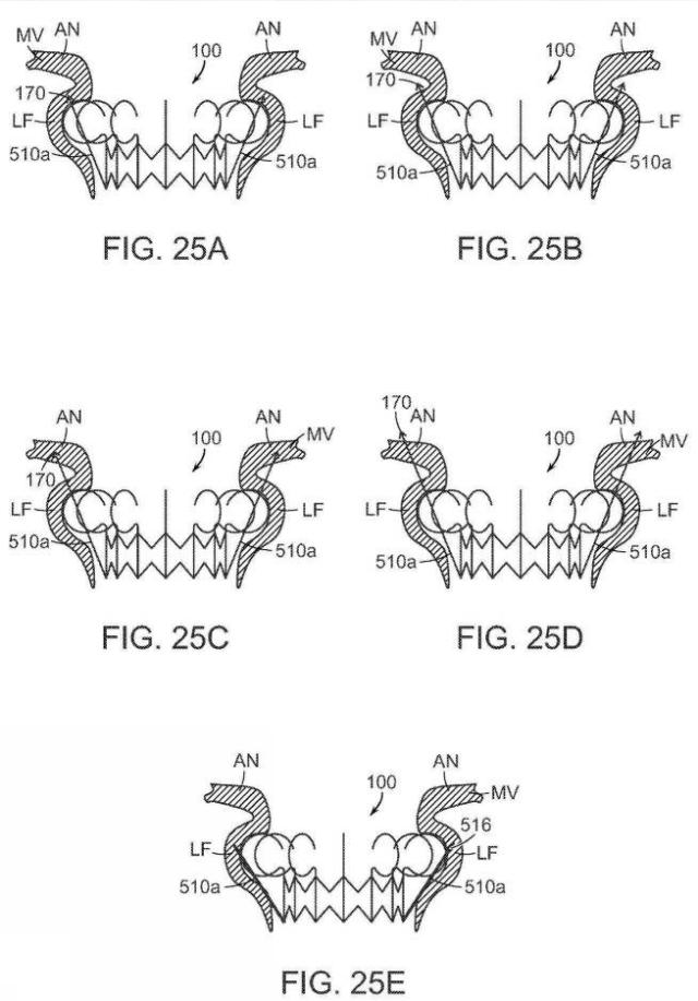 2019022777-心臓弁置換のためのデバイス、システムおよび方法 図000037