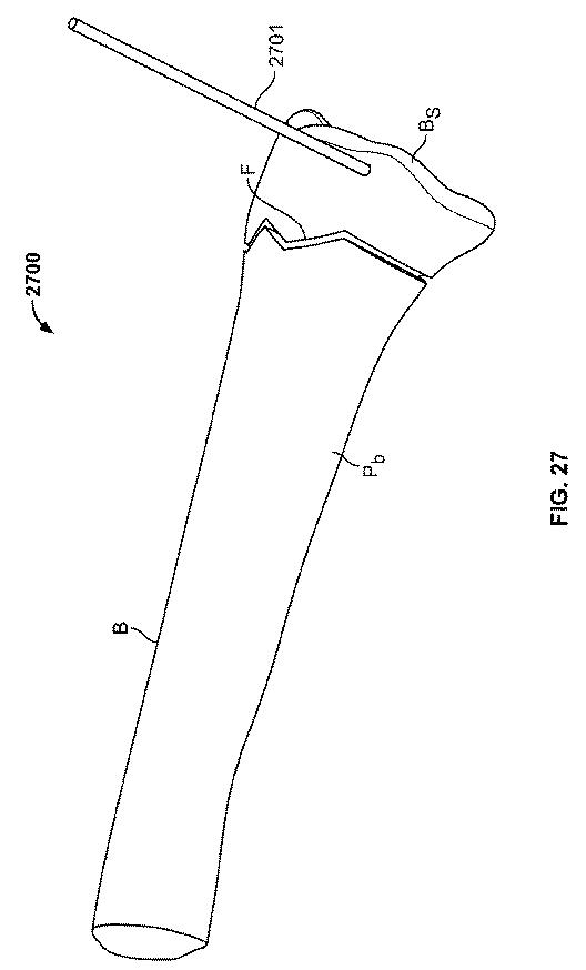 2018114305-骨修復準備のための装置および方法 図000040