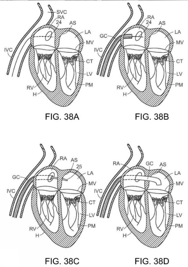 2019022777-心臓弁置換のためのデバイス、システムおよび方法 図000062