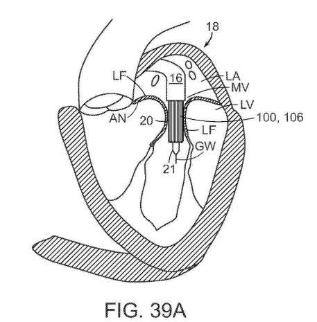 2019022777-心臓弁置換のためのデバイス、システムおよび方法 図000063