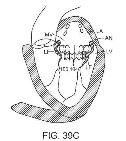 2019022777-心臓弁置換のためのデバイス、システムおよび方法 図000065