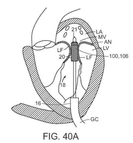 2019022777-心臓弁置換のためのデバイス、システムおよび方法 図000066