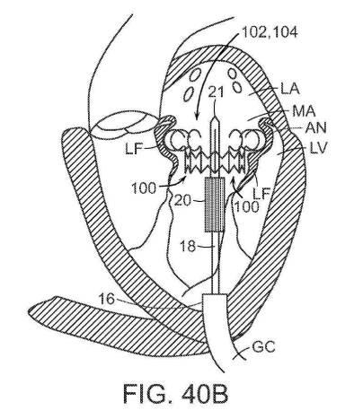 2019022777-心臓弁置換のためのデバイス、システムおよび方法 図000067