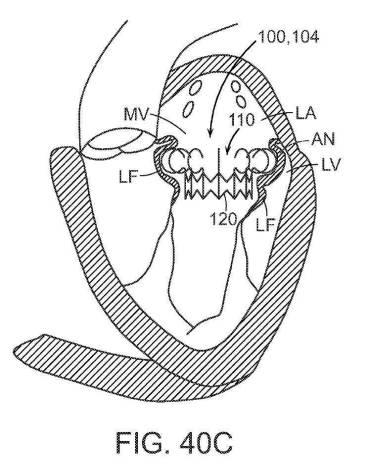 2019022777-心臓弁置換のためのデバイス、システムおよび方法 図000068