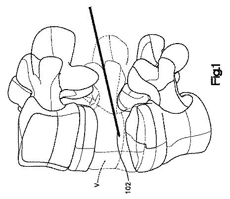 5662999-最小限の侵襲性の脊柱補強及び安定化のシステム及び方法 図000002