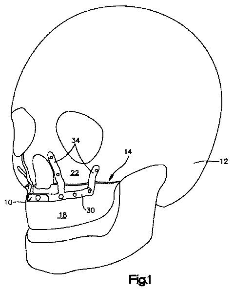 5669929-顎矯正インプラント及びその使用方法 図000002