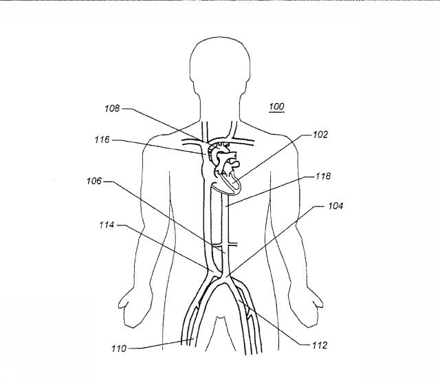 6069392-拡張可能な腸骨シースと使用方法 図000002