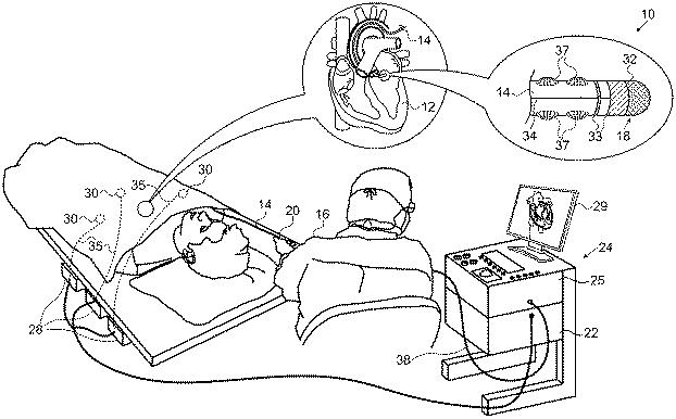 6214940-熱伝導を向上させた灌注式電極 図000002