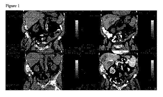 6278597-腫瘍の一掃のための方法および組成物 図000002