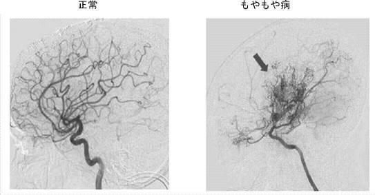 6281111-もやもや病診断用バイオマーカー 図000002
