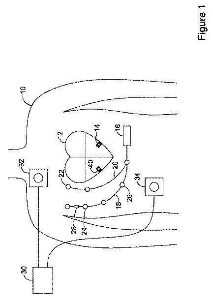 6764956-再同期ペーシング管理に皮下で感知されたＰ波を使用する心臓治療法システム 図000002