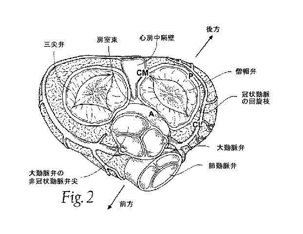 5647680-一体的な迅速接続人工心臓弁ならびに配備のシステムおよび方法 図000003