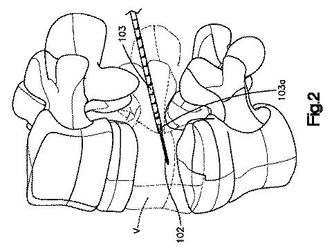 5662999-最小限の侵襲性の脊柱補強及び安定化のシステム及び方法 図000003