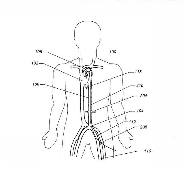 6069392-拡張可能な腸骨シースと使用方法 図000003