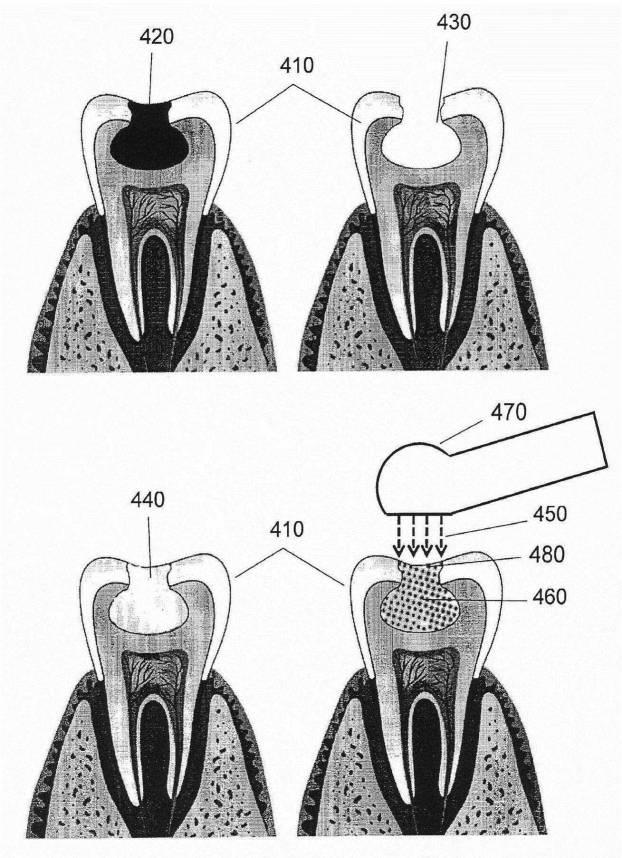 6084287-発光結晶を含む歯科修復用複合材料 図000003