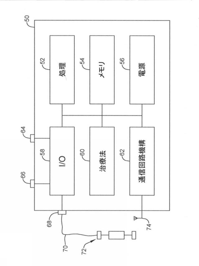 6764956-再同期ペーシング管理に皮下で感知されたＰ波を使用する心臓治療法システム 図000003