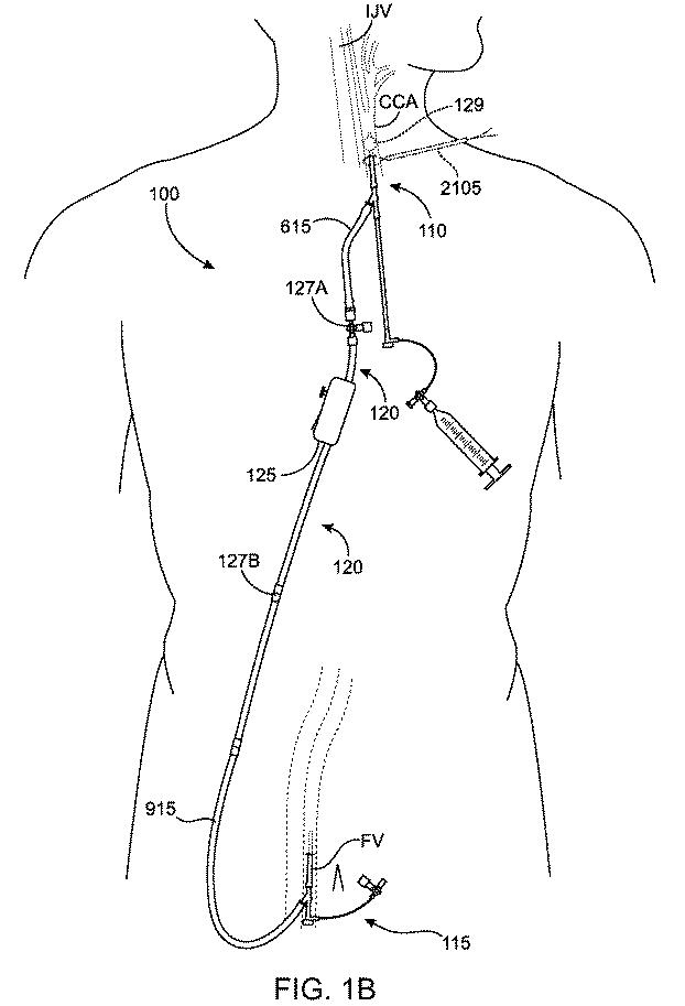 6768697-頚動脈血流の逆流を確立する方法およびシステム 図000003