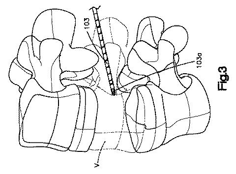 5662999-最小限の侵襲性の脊柱補強及び安定化のシステム及び方法 図000004