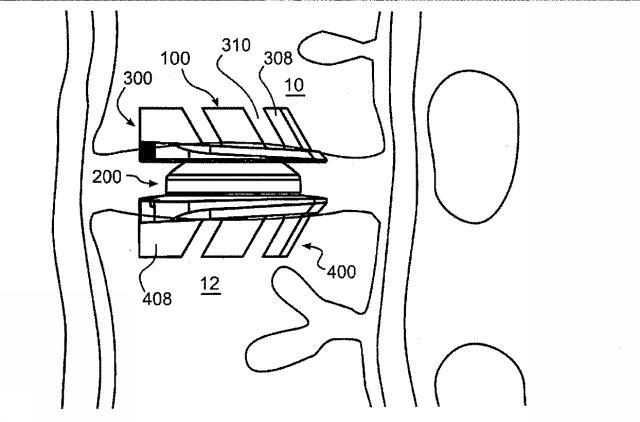 6243963-６運動自由度の脊椎安定化デバイスおよび方法 図000004