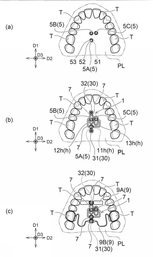 6770282-歯科矯正用インプラント装置に用いられるベース部材 図000004