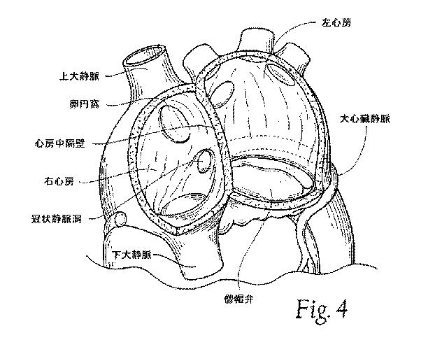 5647680-一体的な迅速接続人工心臓弁ならびに配備のシステムおよび方法 図000005