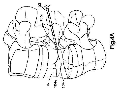 5662999-最小限の侵襲性の脊柱補強及び安定化のシステム及び方法 図000005