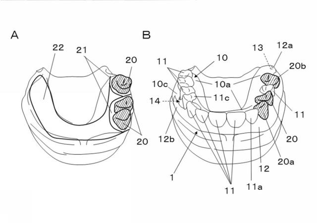 5720012-入れ歯 図000005