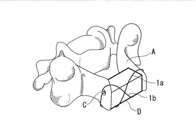 5870473-骨移植用縫合具 図000005