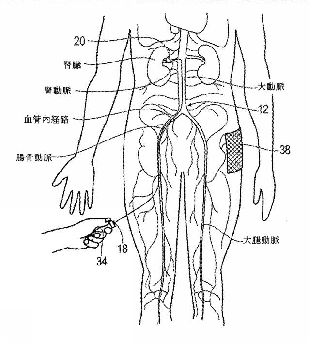 6267774-神経変調療法の評価及びフィードバックのためのデバイス、システム、及び方法 図000005