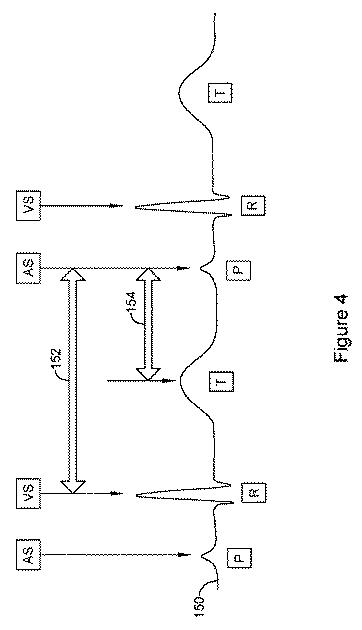 6764956-再同期ペーシング管理に皮下で感知されたＰ波を使用する心臓治療法システム 図000005