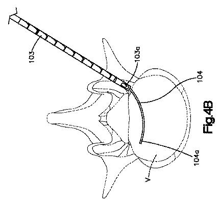 5662999-最小限の侵襲性の脊柱補強及び安定化のシステム及び方法 図000006