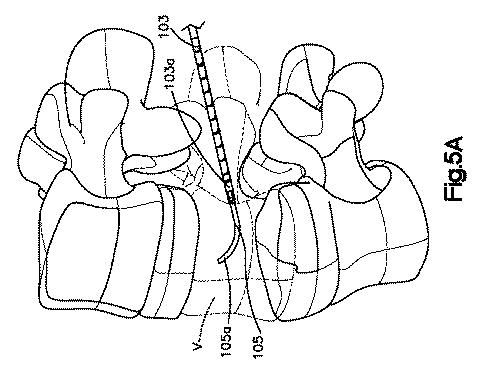 5662999-最小限の侵襲性の脊柱補強及び安定化のシステム及び方法 図000007