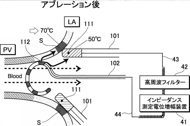 5913739-バルーンカテーテルアブレーションシステム 図000007