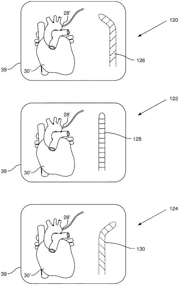 6219023-カテーテルの偏向を指示するためのシステム 図000007