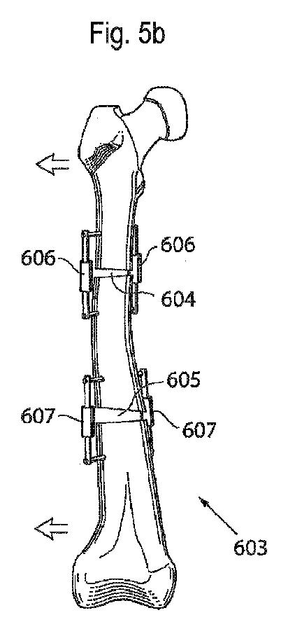 6636420-骨整形用の装置および方法 図000007