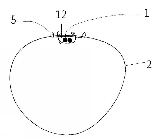 6717851-人口腱の取付け方法および製品 図000007