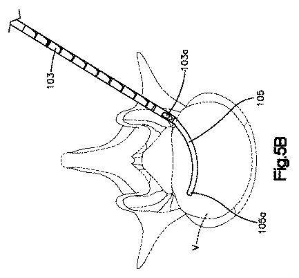 5662999-最小限の侵襲性の脊柱補強及び安定化のシステム及び方法 図000008