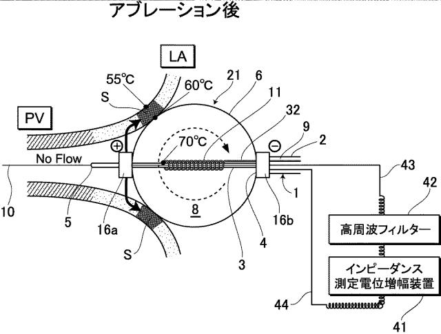 5913739-バルーンカテーテルアブレーションシステム 図000008