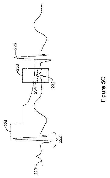 6764956-再同期ペーシング管理に皮下で感知されたＰ波を使用する心臓治療法システム 図000008