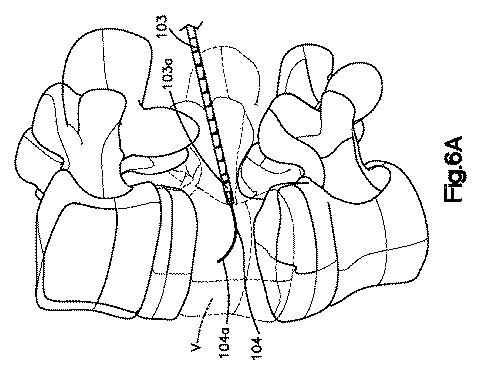 5662999-最小限の侵襲性の脊柱補強及び安定化のシステム及び方法 図000009